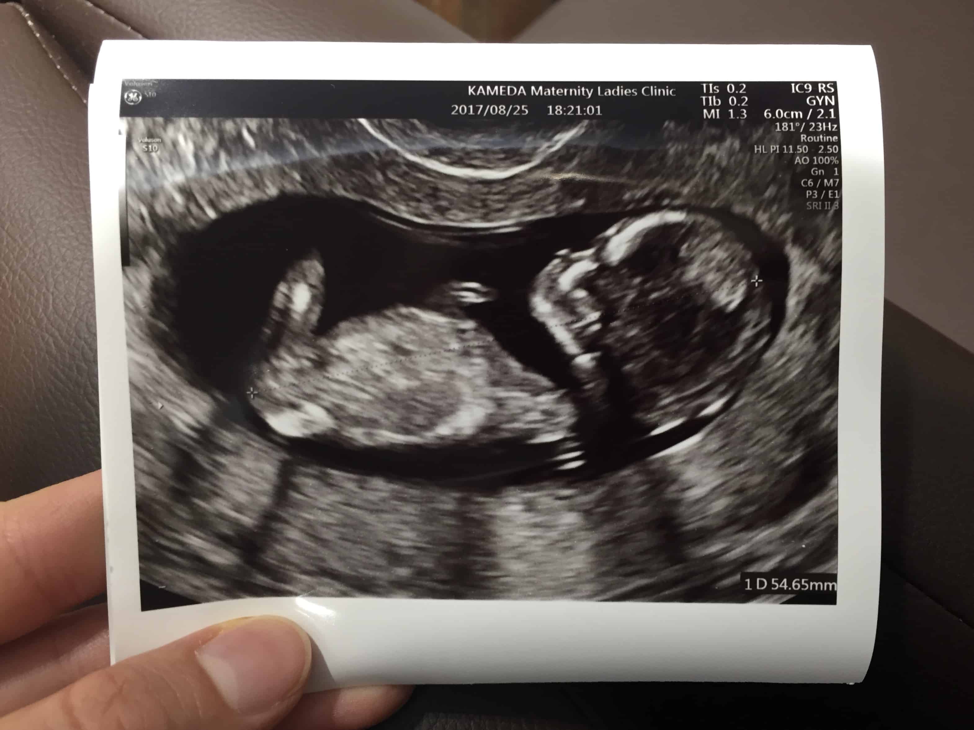 pregnant